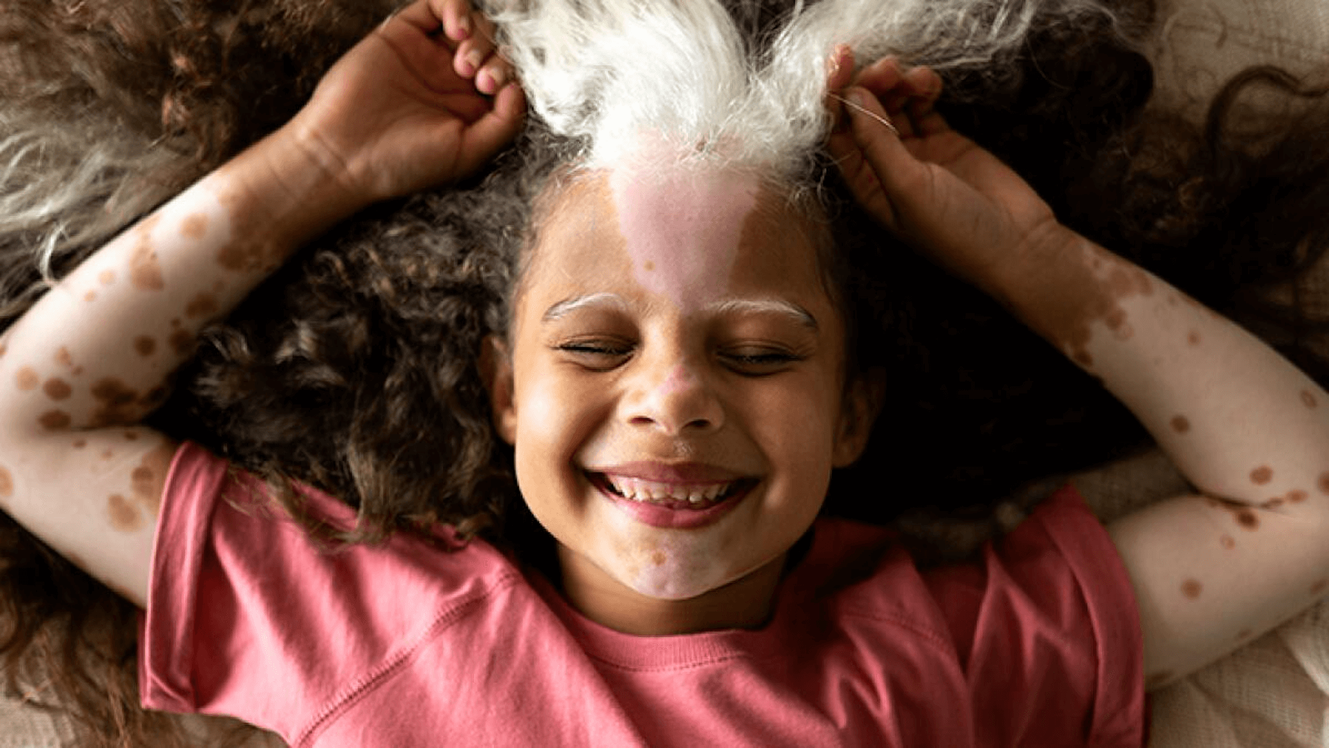 vitiligo kids
